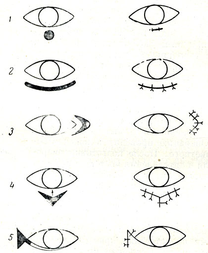 . 75.   : 1, 2, 3 -   ; 4, 5 -   
